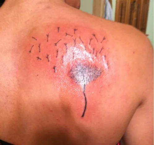 Xóa xăm bằng thuốc tím có thể gây kích ứng da xoa xam bang thuoc tim tien mat tat mang2