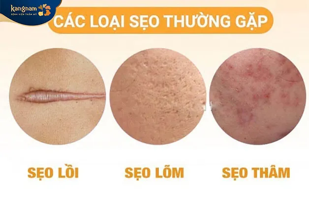 3 trường hợp sẹo thường gặp nhất: sẹo lồi - lõm - thâm lâu năm