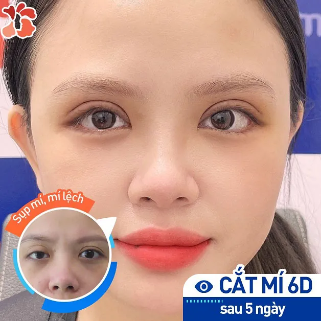 Mí mắt đẹp ngay sau 5 ngày nhờ công nghệ 6D tiên tiến
