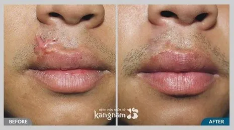 Phần mô sẹo xấu đã được xử lý, trả lại đôi môi mềm mịn