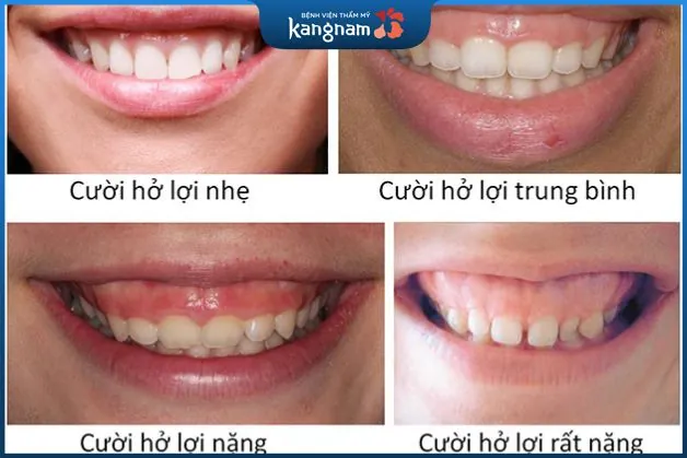 Mức độ cười hở lợi