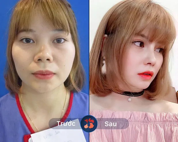 Cánh mũi hếch, thô được khắc phục hiệu quả sau nâng mũi