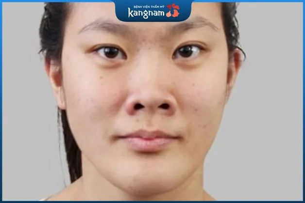 Mũi hếch khiến gương mặt trở nên kém thiện cảm