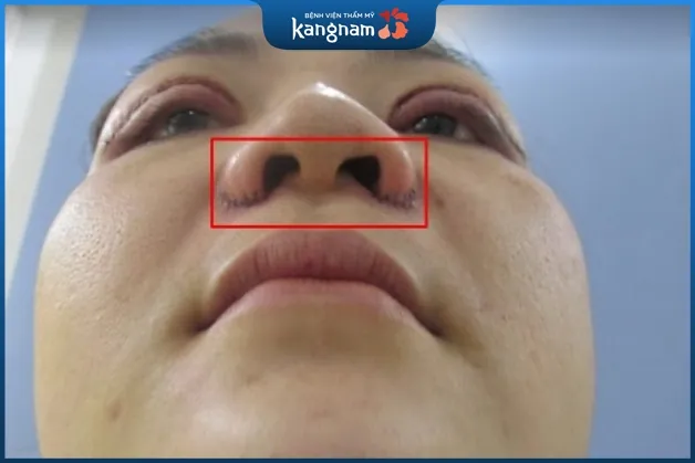 Ăn ốc để lại sẹo sau khi cắt cánh mũi