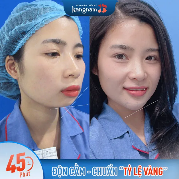 Cằm lẹm, cằm to bệnh, thô cứng được khắc phục hoàn toàn