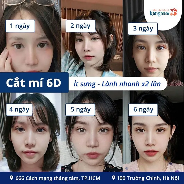 Cắt mí 6D hồi phục nhanh