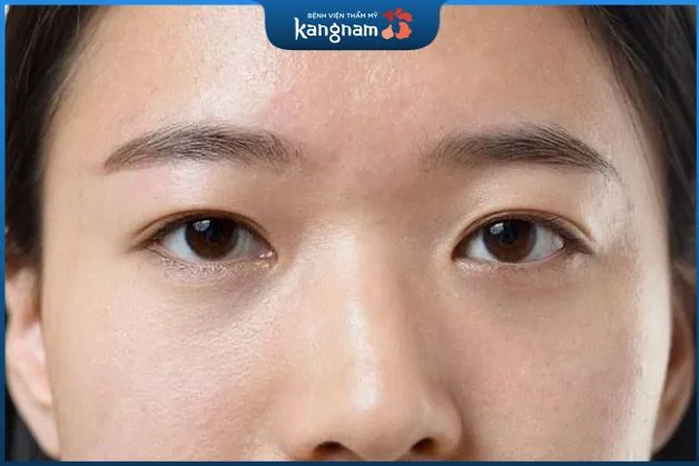 Sụp mí có thể thực hiện phun mí giúp mắt to hơn