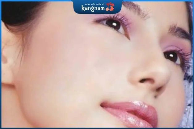 nốt ruồi ở lỗ mũi