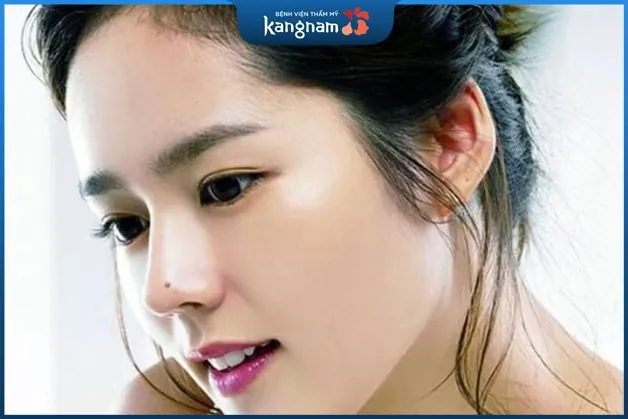 Nốt ruồi ở mũi 