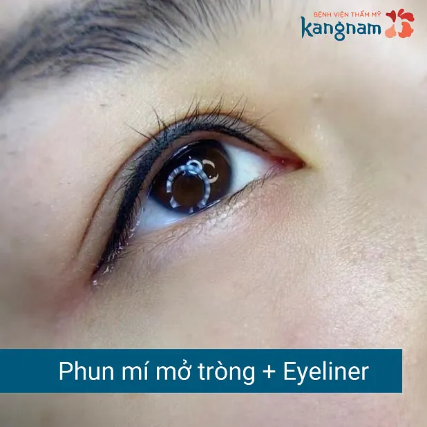 Phun mí khắc phục tốt tình trạng mí mắt sụp