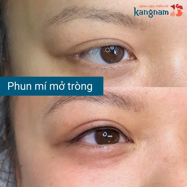 Đôi mắt có sức sống và sắc nét hơn sau khi phun mí