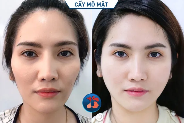Chị khách trẻ hơn sau khi độn thái dương và cấy mỡ mặt vùng má