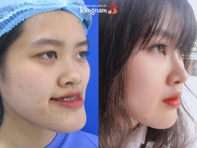 Chỉnh gò má và chỉnh hàm móm tại Kangnam