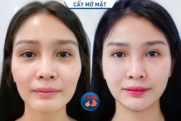 Độn thái dương kết hợp cấy mỡ mặt, giúp khách hàng trở nên tươi tắn và trẻ hơn