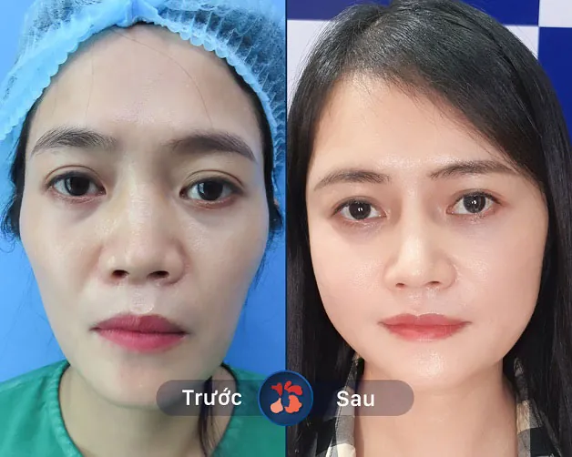 Khắc phục thái dương hóp, lõm nhanh chóng, không cần nghỉ dưỡng lâu dài