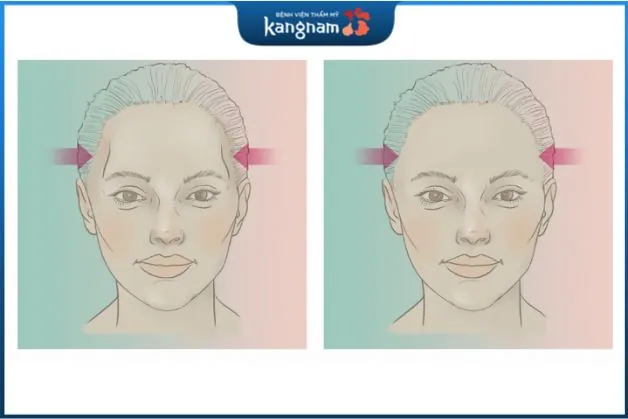 Độn thái dương là phương pháp làm đẹp giúp khắc phục vùng thái dương bị hóp