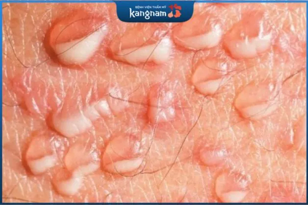 Giai đoạn tái phát của mụn rộp sinh dục