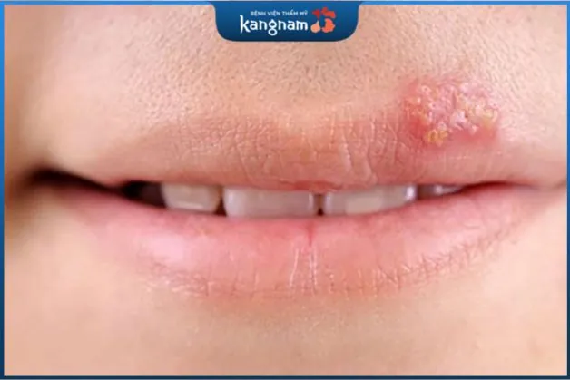 Mụn có thể xuất hiện ở quanh miệng