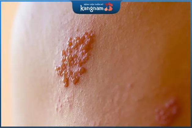 Khả năng lây lan của mụn rộp sinh dục