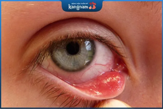 Nhiễm trùng mắt