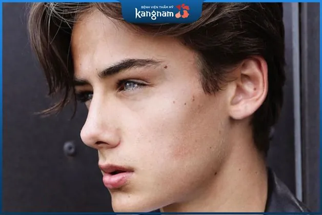 Nốt ruồi đuôi lông mày phải của nam