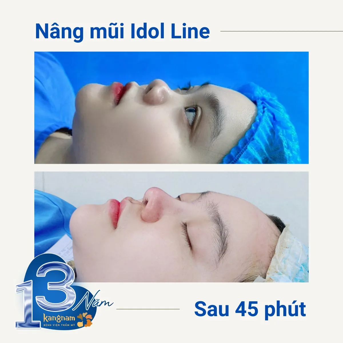 Nâng mũi Nanoform có nhiều ưu điểm vượt trội