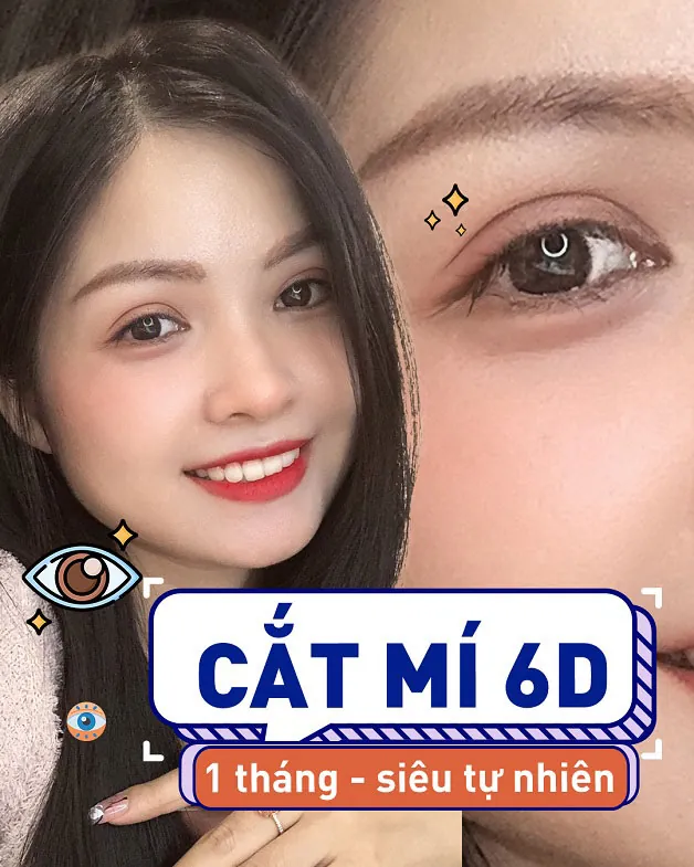 Cắt mí 6D đẹp tự nhiên