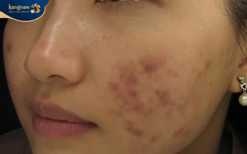 Mụn mủ mọc ở má trái