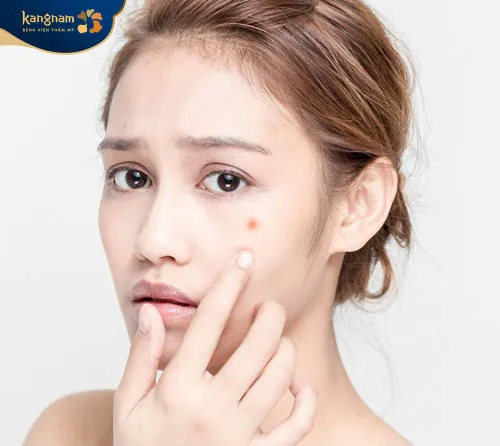 Mọc mụn ở gò má