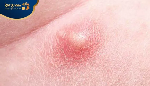 Trường hợp ổ mụn sưng to cần tìm đến bác sĩ da liễu