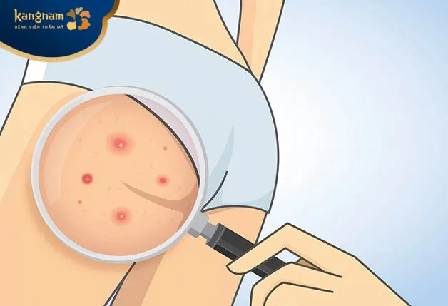 Mụn nhọt ở vùng mông nếu có cách điều trị hiệu quả sẽ không nguy hiểm