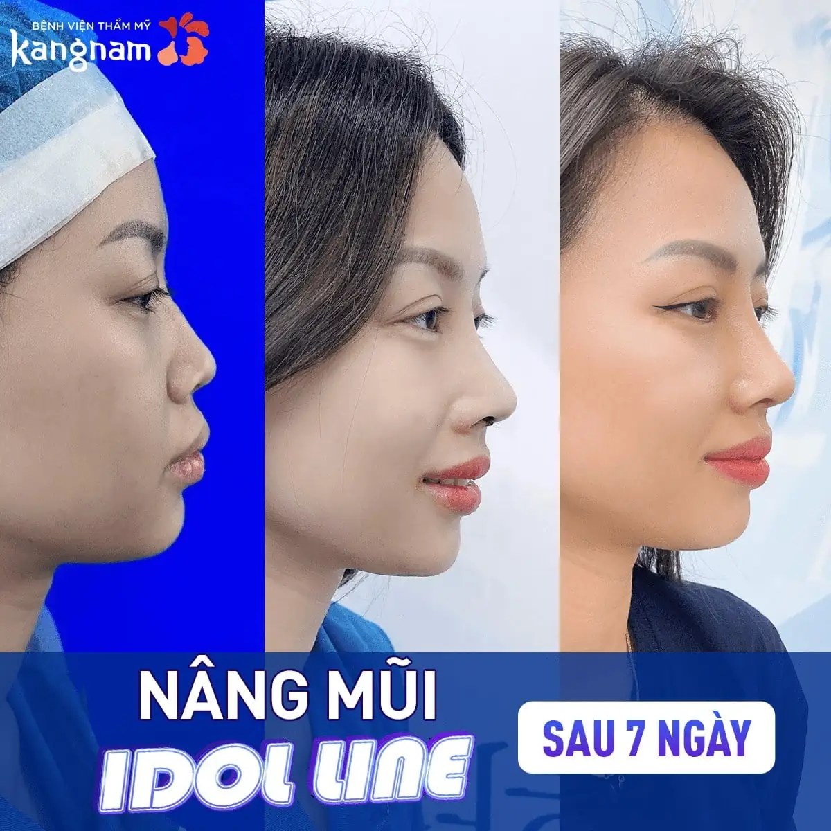 Sống mũi cao tự nhiên, hài hòa với gương mặt