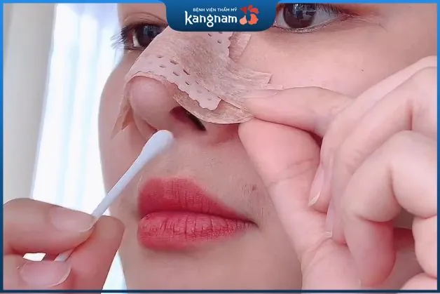 Nẹp sống mũi thường được sử dụng để cố định và bảo vệ mũi khỏi các va đập