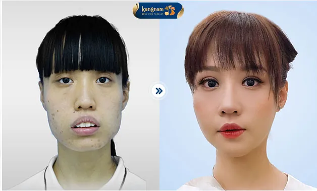 Gương mặt thon gọn, khuôn hàm xinh xắn sau khi chỉnh hàm hô