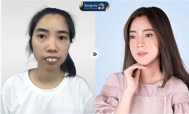 Khách hàng thay đổi diện mạo ngoạn mục sau khi chỉnh sửa hàm vẩu nặng