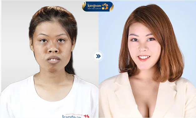 Hết hô, hết tự ti, sở hữu diện mạo xinh xắn và nụ cười rạng rỡ