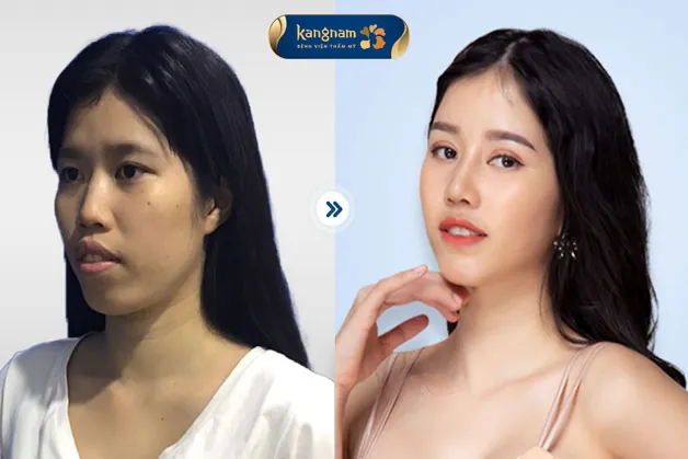 Sở hữu diện mạo xinh hoàn hảo sau khi khắc phục hàm hô