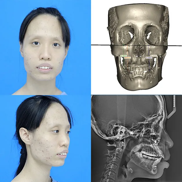 Phương pháp chỉnh hàm hô