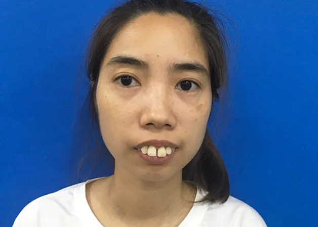 Mức độ vẩu nặng ảnh hưởng nhiều đến ngoại hình và sự tự tin