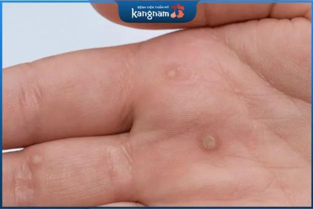 Chẩn đoán mụn hạt cơm ở tay thường dựa trên các dấu hiệu và triệu chứng