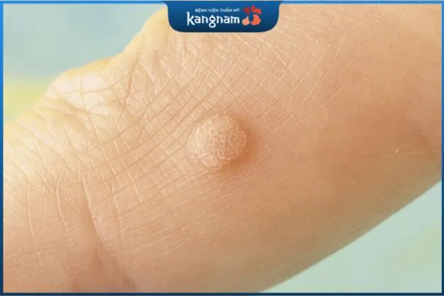 Mụn cóc phẳng không gây đau đớn, thường xuất hiện dưới dạng cụm