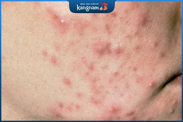 Ngưng bôi rượu thuốc khi có phản ứng bất thường