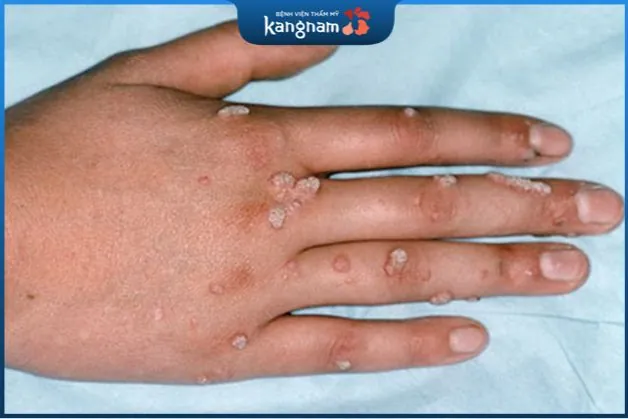 Theo các chuyên gia da liễu, nguyên nhân chính gây ra mụn cơm là do virus HPV