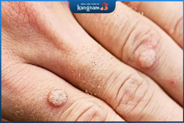 Tỷ lệ mắc bệnh mụn hạt cơm ở trẻ em cao hơn đáng kể so với người lớn