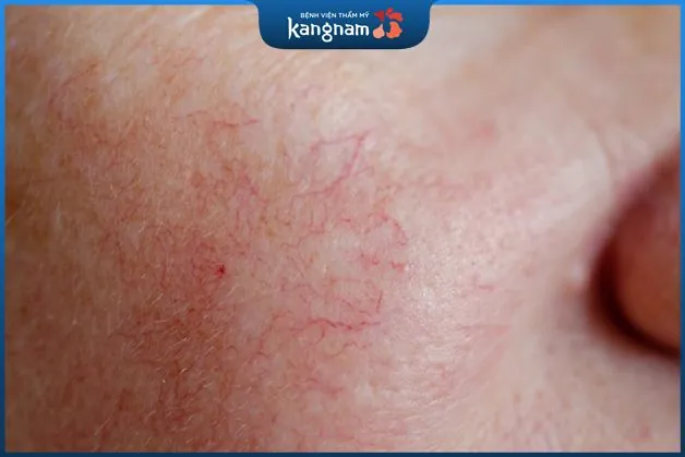 Dùng thuốc ngâm từ rượu có thể gây kích ứng