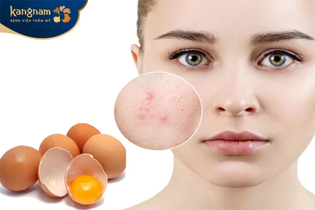 Enzym Lysozyme trong trứng gà sẽ tiêu diệt vi khuẩn và làm se cồi mụn