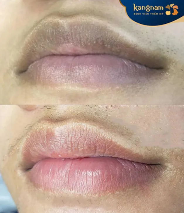 Khử môi thâm nhanh chóng, an toàn và hiệu quả