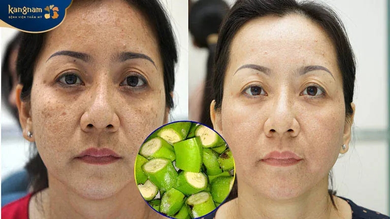 Nên sơ chế chuối xanh trước khi sử dụng