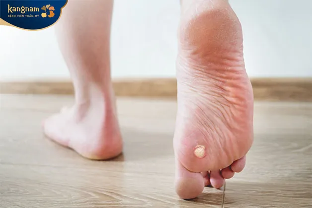 Những nốt mụn sưng đỏ có dịch mủ bên trong