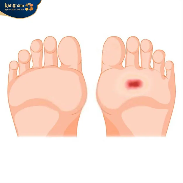 Chỉ một vết xước nhỏ cũng có thể khiến mụn hình thành